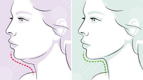 光纤溶脂瘦脸恢复过程图