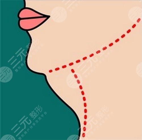 光纤溶脂瘦脸恢复过程图