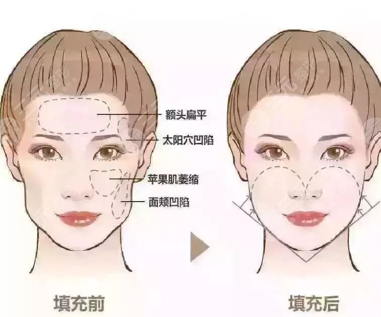 自体脂肪丰面颊是怎么做的 是否降低风险