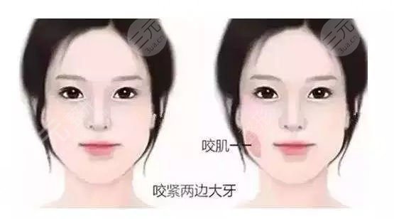 咬肌太肥大怎么办