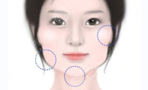 如果你的脸是正方形怎么办？韩式微创改脸型帮你改变正方形、角方