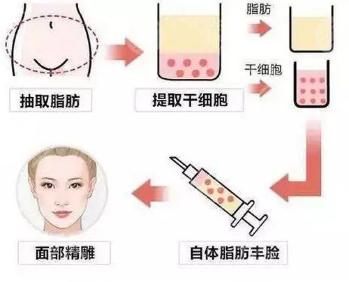 面部脂肪填充多久可以化妆