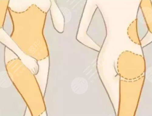 打注射瘦腿多少钱？多少钱一针比较合适？