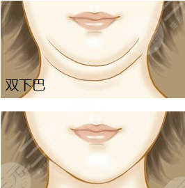 面部吸脂会不会反弹