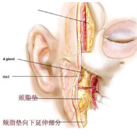 去颊脂垫手术会有后遗症吗 去颊脂垫手术前后对比果照片图