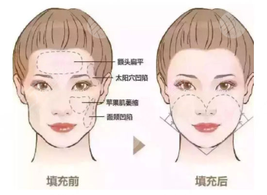 脂肪填充太阳穴多久恢复?