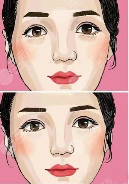 脸部颧骨整形美容手术的优点
