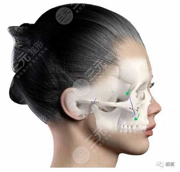 颧骨整形的手术方法 颧骨整形的方法有哪些