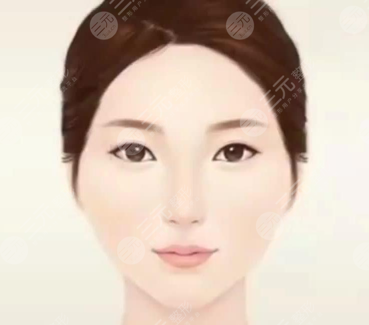 颧骨充填增高整形手术果