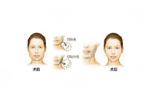 磨颧骨整形手术前后对比图 磨颧骨一周照片