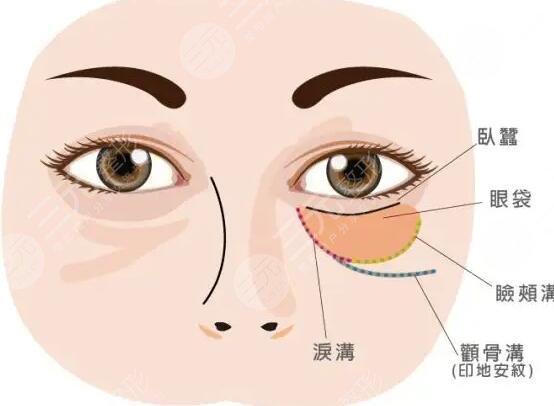 长春去眼袋手术案例