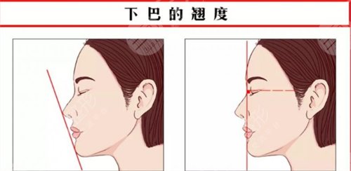 玻尿酸垫下巴可以维持多久