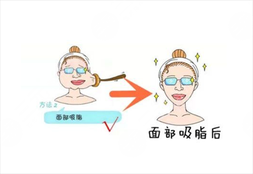 郑州面部吸脂降低风险吗