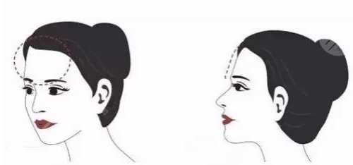 去颊脂垫手术后口腔会肿胀吗