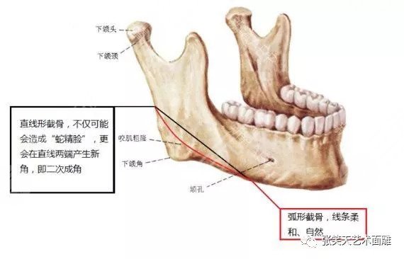 下颌角肥大整形瘦脸果好不好 下颌角肥大整形瘦脸果好不好
