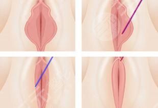 私密整形阴蒂肥大缩小手术的方法介绍