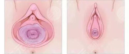 关于私密整形，阴唇整形手术能多久恢复？