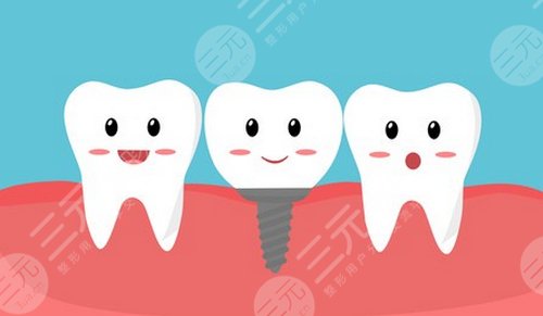 种植牙术后应该如何护理
