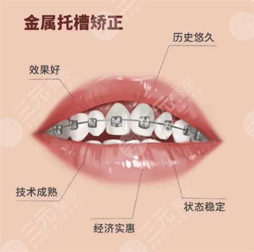 牙科私人贵还是医院贵带牙套