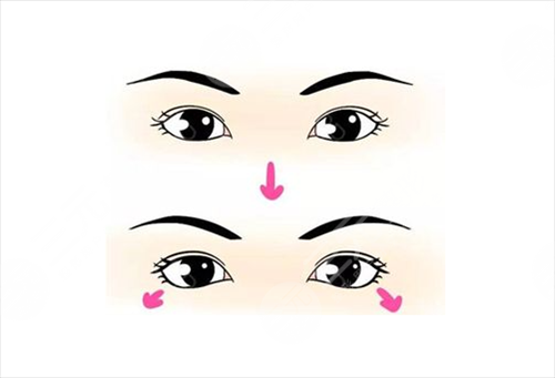 眼睑下垂可以做矫正手术吗