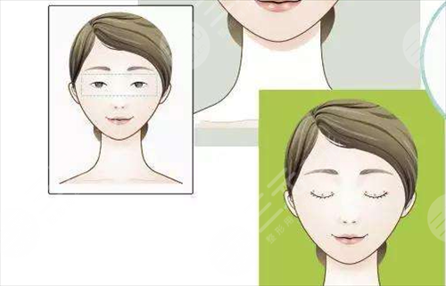 眼睑下垂有哪些症状