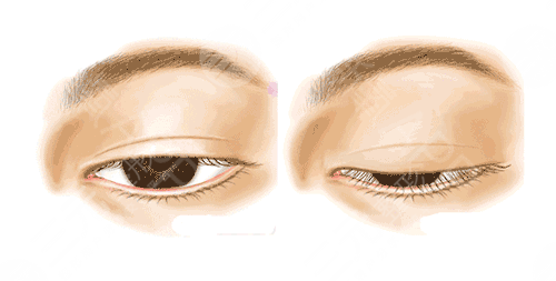 眼睑下垂有哪些症状