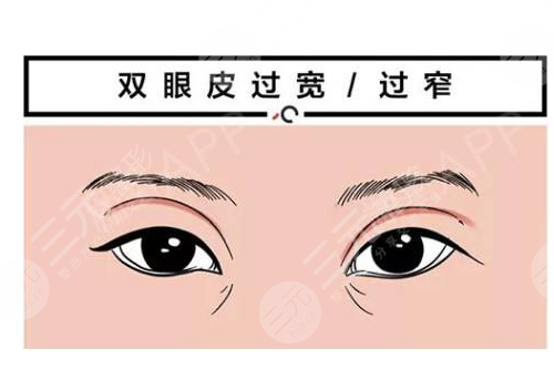 眼睑下垂手术多久恢复