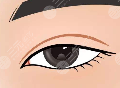 眼睑下垂的矫正方法 眼睑下垂矫正注意事项