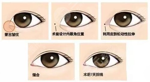 眼睑下至术