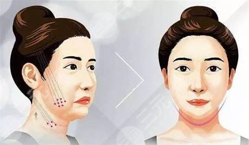 面部整形微针除皱术成好吗?