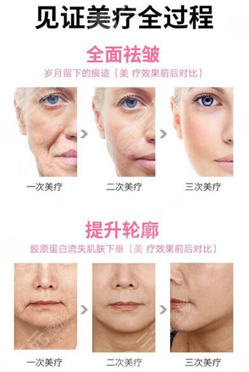 除皱的方法有哪些?有什么风险和副作用吗? 除皱的方法有哪些?有什么风险和副作用吗?