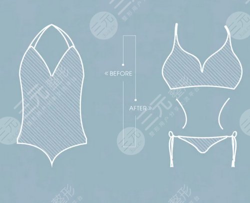 臀部吸脂会造成皮肤松弛吗