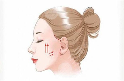 面部美容小切口除皱术的方法有哪些?