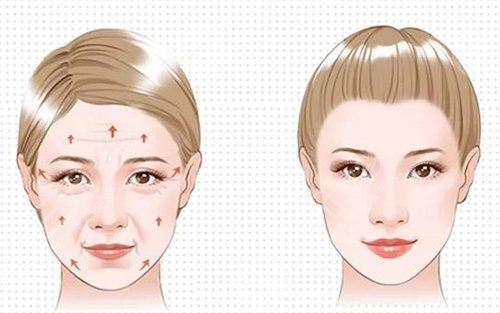 全脸拉皮手术|面部年轻化整形美容项目价格分享