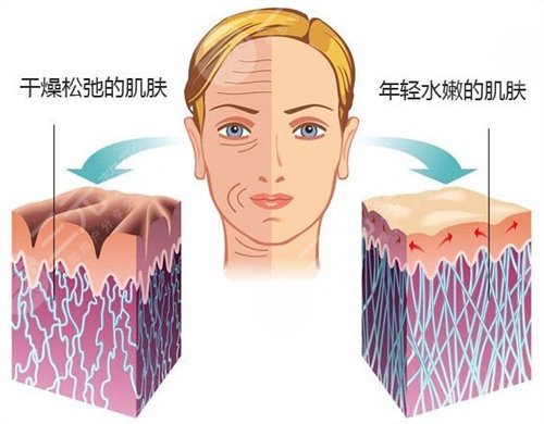 自己注射玻尿酸可不可以?玻尿酸注射需要注意什么? 自己注射玻尿酸可不可以?玻尿酸注射需要注意什么?