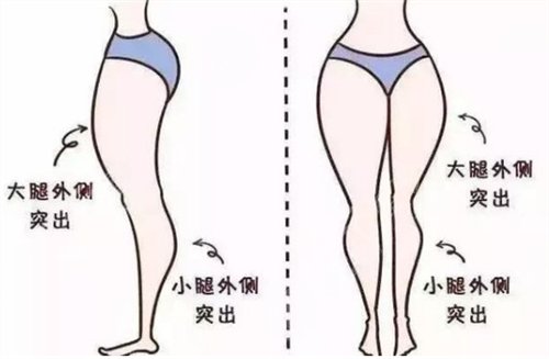 比目鱼肌发达的小腿图、小腿可以打注射瘦腿吗