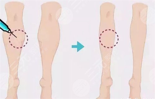 注射瘦腿有吗 注射注射瘦腿前后对比图