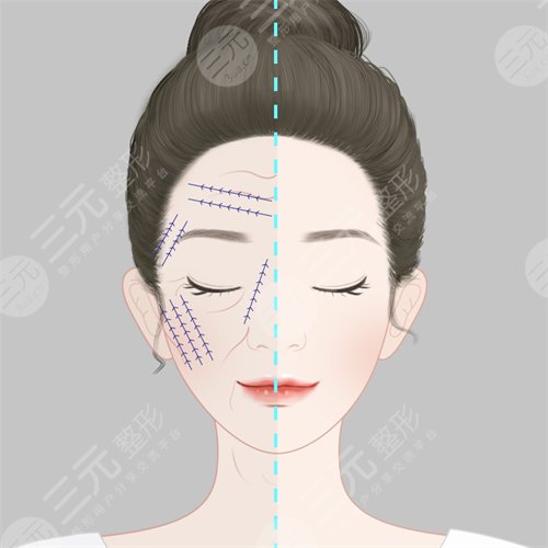 关于所有额面部除皱术你应该知道的 关于所有额面部除皱术你应该知道的