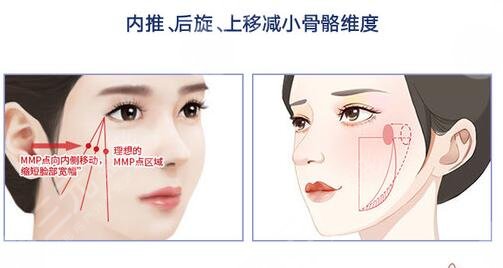 重庆颧骨降低价格是多少?为什么你的价格跟别人的差距大?是被坑了吗?