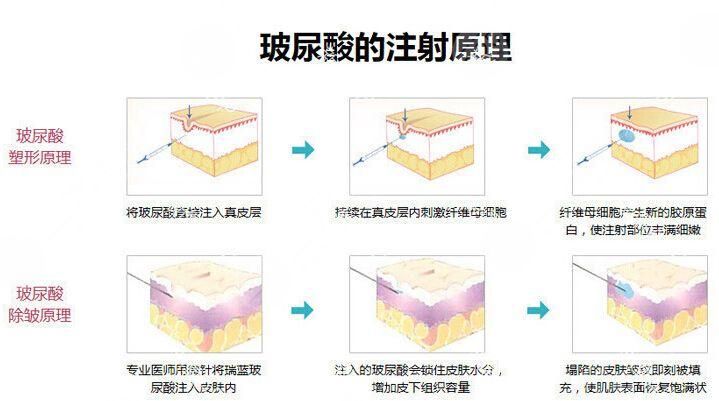 透明质酸其实它还有一个别名,它还被人们称为玻尿酸.