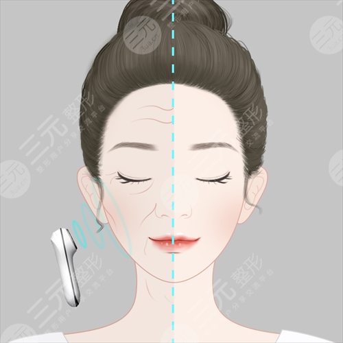 电波l皮适合多少岁的人除皱?果怎么样? 电波l皮适合多少岁的人除皱?果怎么样?