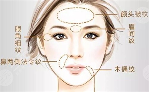 注射瘦脸生物除皱的果怎么样?可以保持多久? 注射瘦脸生物除皱的果怎么样?可以保持多久?