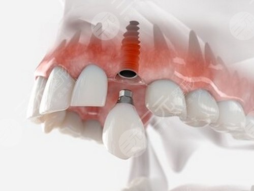 牙齿畸形不同种类矫正方法