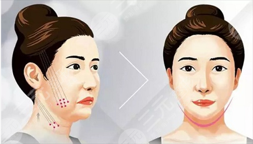 热玛注射瘦脸合多大年龄的人做?听说是30+姐姐的专属?事实如此吗? 热玛注射瘦脸合多大年龄的人做?听说是30+姐姐的专属?事实如此吗?