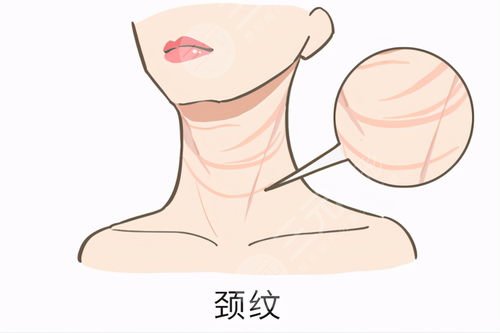 颈部除皱提升术的方法有哪些
