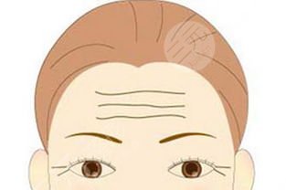 玻尿酸去抬头纹能坚持多久?有没有副作用? 玻尿酸去抬头纹能坚持多久?有没有副作用?