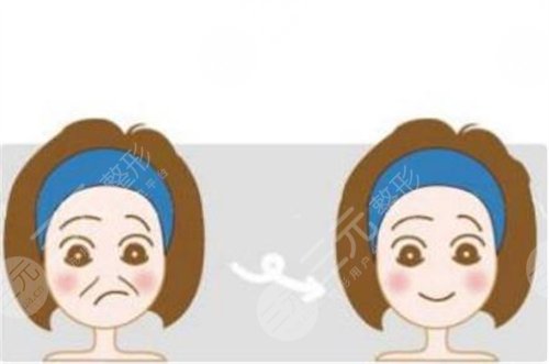 法令纹太深怎么办？填充前后照片及经历记录