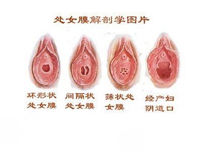 女性私密整形处女膜修复的**高吗?