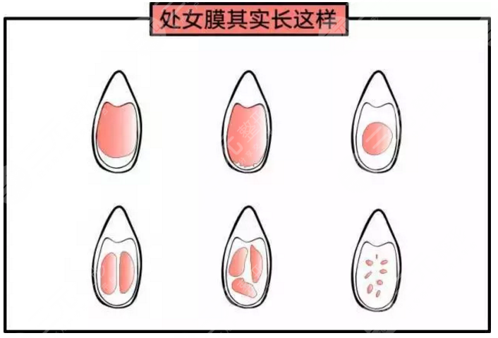 女性私密整形处女膜修补手术有风险吗?