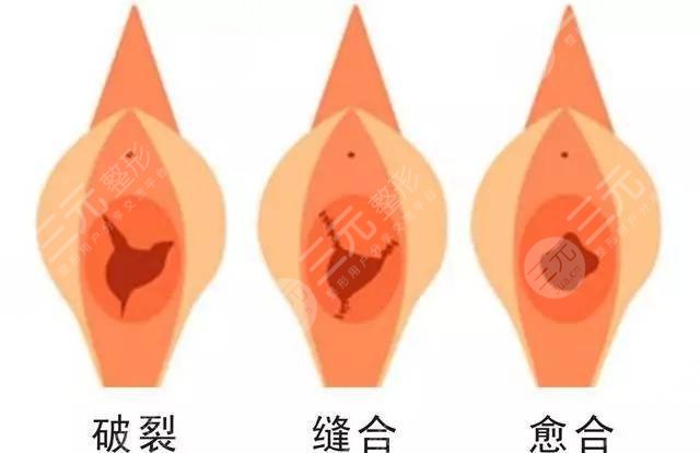 女性私密整形韩式处女膜修补手术果如何?